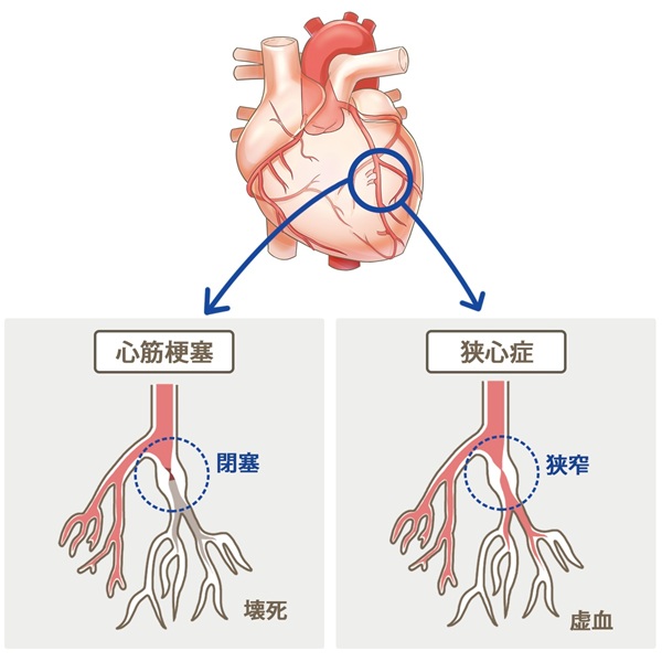 心筋梗塞と狭心症